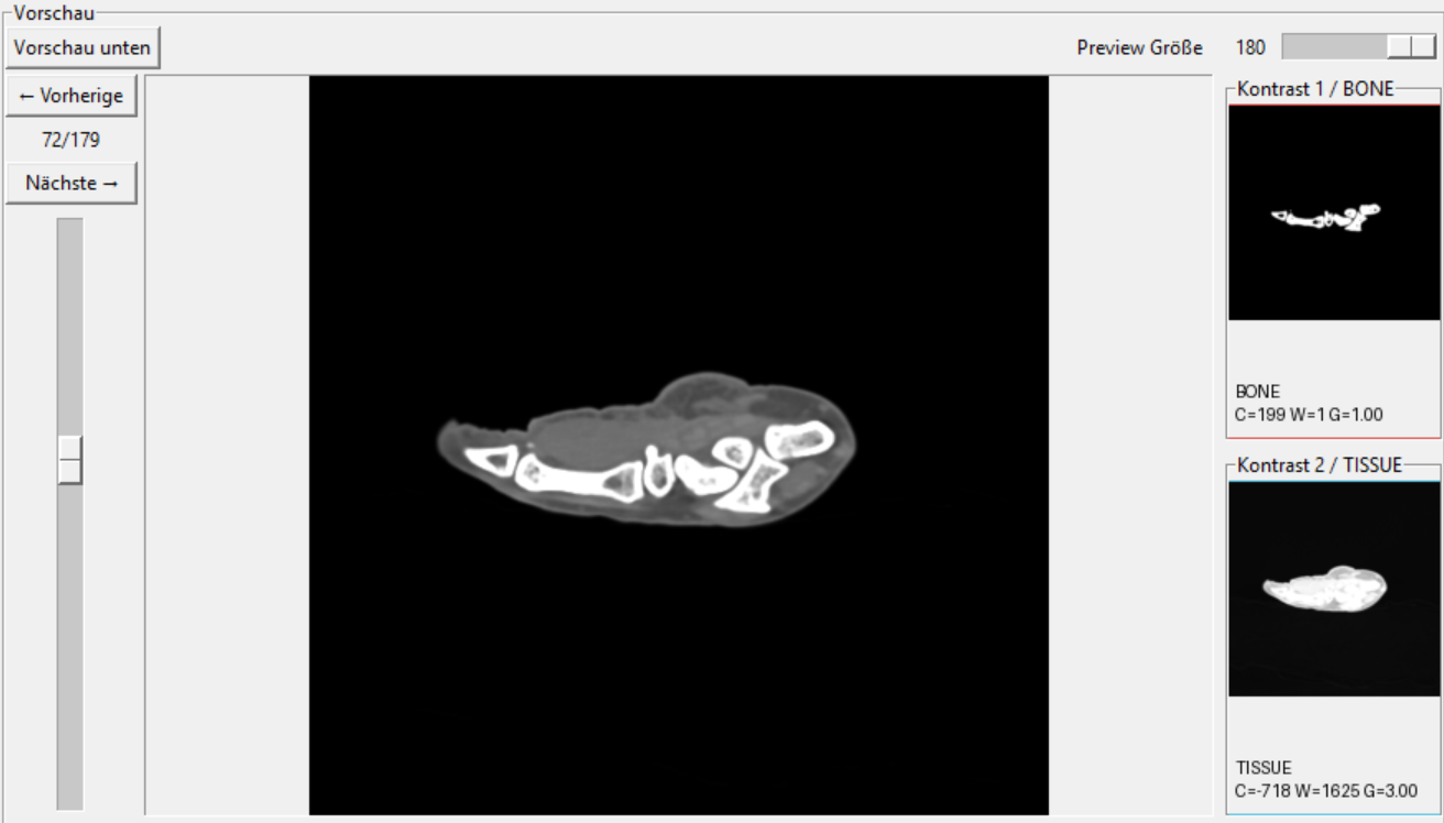 Wrist CT preview
